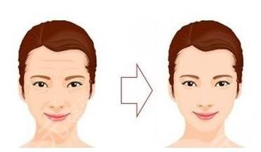 天津第三中心醫(yī)院整形美容科面部抗衰抗皺手術(shù)經(jīng)歷分享