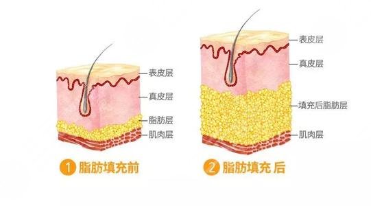 填充額頭多少錢？玻尿酸or自體脂肪？一文詳解豐額頭的秘籍，馬??！