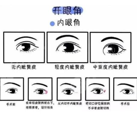 開(kāi)內(nèi)眼角手術(shù)注意什么