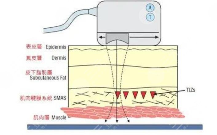 深藍(lán)射頻和光子嫩膚哪個(gè)好？果和區(qū)別科普！醫(yī)美護(hù)膚入門攻略~