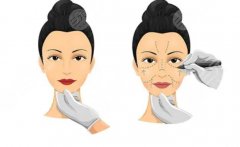 拉皮手術(shù)多大年齡做合適？到底是20+、30+，還是40+