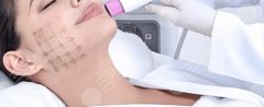 什么是熱瑪吉美容？作用原理|優(yōu)點(diǎn)|適合人群全講解，2022除皺指南！