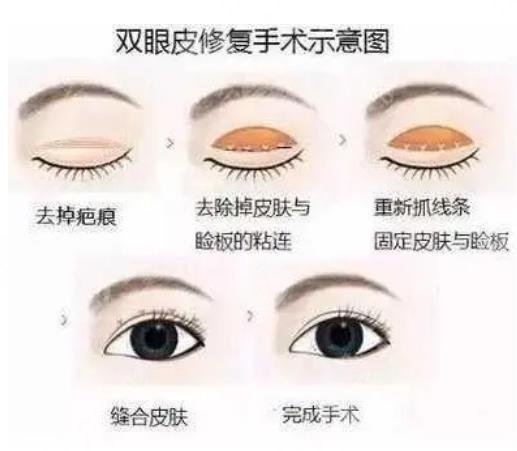 天津雙眼皮失敗修復價格多少錢?價格受什么因素影響?