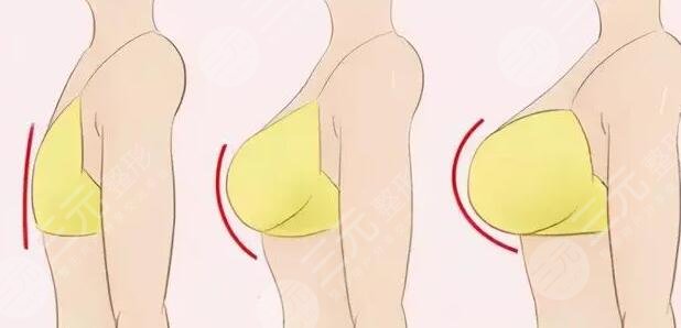 假體放置位置對包膜攣縮的影響