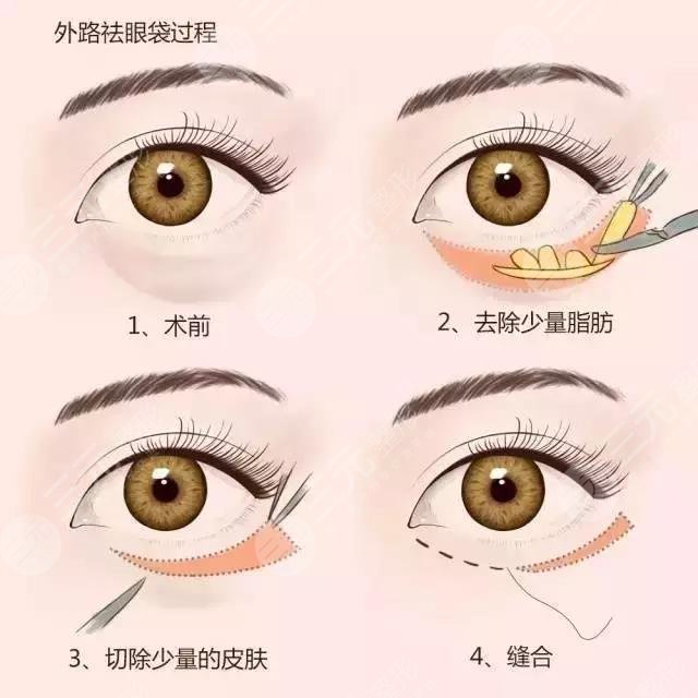 外切手術(shù)去眼袋