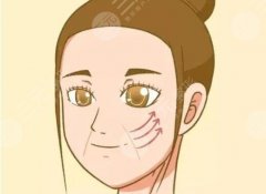 7d聚拉提果維持多久？南韓新款緊膚除皺設(shè)備，醫(yī)美小課堂講解！