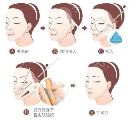 面部抗衰的原理