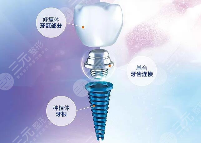 種植牙