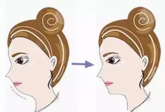 下頜角磨骨術(shù)恢復(fù)時間科普！想變美，術(shù)前功課不能少！