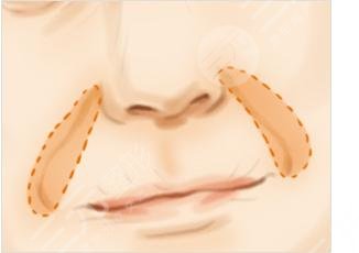 怎么消除法令紋?補(bǔ)充膠原蛋白真有用?是不是智商稅看了就明白!