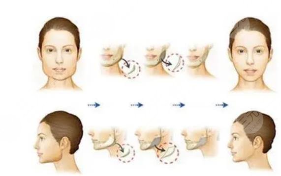 磨骨手術(shù)需要多少錢