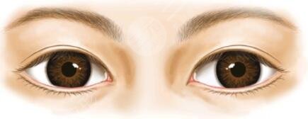 開(kāi)內(nèi)外眼角