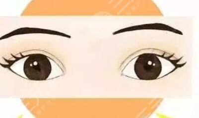 開(kāi)內(nèi)外眼角