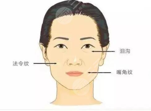 自體脂肪面部填充，年輕才是真的美~~~