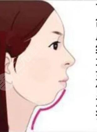 下頜角磨骨整形