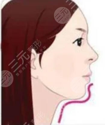 廣州曙光醫(yī)學美容醫(yī)院,假體墊下巴