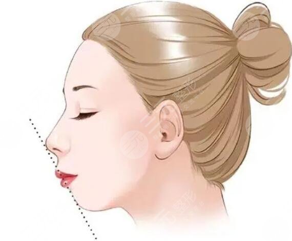 廣州曙光醫(yī)學美容醫(yī)院,假體墊下巴