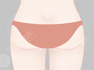 大腿部吸脂減肥果前后對比圖 大腿部吸脂手術恢復全過程