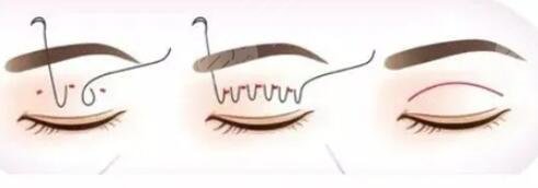 全切雙眼皮7mm+開眼角整形手術(shù)果圖恢復(fù)全過程