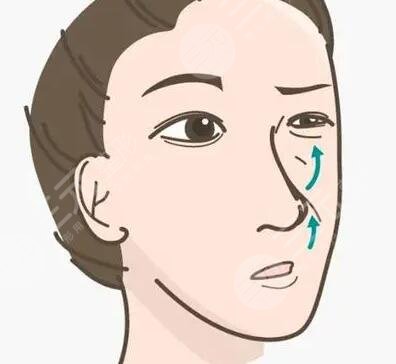 耳軟骨墊鼻尖假體隆鼻手術(shù)后神似林小宅，真實(shí)案例照片分享