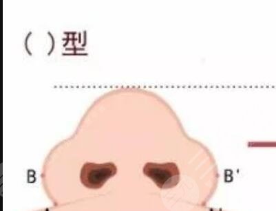 鷹鉤鼻矯正整形手術(shù)真人案例 鷹鉤鼻矯正多少錢