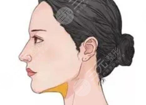 V-line手術(shù)改良了我的方下巴