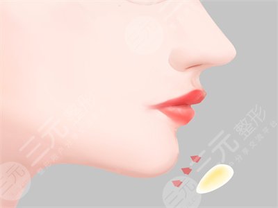 V-line手術(shù)改良了我的方下巴