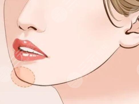 V-line手術(shù)改良了我的方下巴