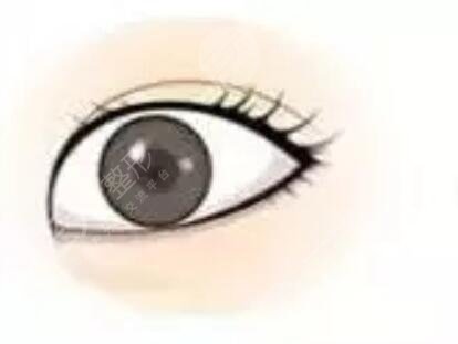 全切扇形雙眼皮恢復(fù)6個(gè)月很好看喲~