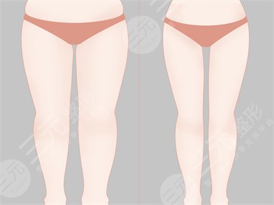 自體脂肪面部填充90天恢復(fù)圖分享