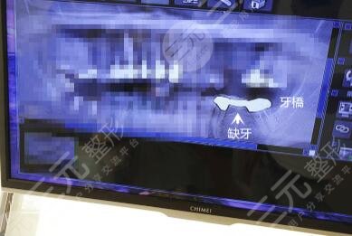 種植牙有什么副作用?