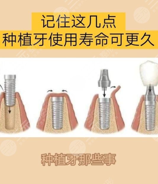 種植牙可以用多久壽命