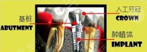 種植牙術前準備事項