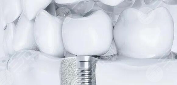 種植牙的壽命一般能GET10年以上?