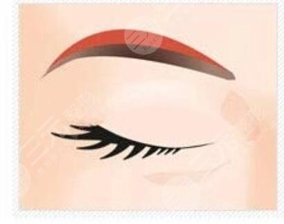 切眉手術(shù)1-7天的前后對(duì)比圖，恢復(fù)過程沒有什么后遺癥出現(xiàn)