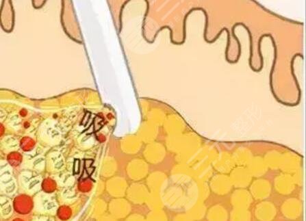 水動(dòng)力吸脂瘦身減肥整形日記