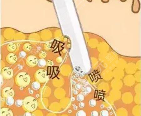 水動(dòng)力吸脂瘦身減肥整形日記