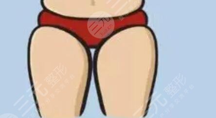 大腿吸脂減肥后恢復過程_真實案例分享