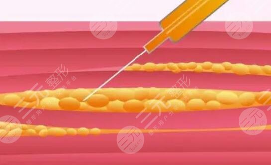 大腿吸脂減肥后恢復過程_真實案例分享