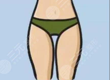 大腿吸脂減肥后恢復過程_真實案例分享