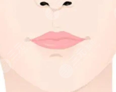 m唇手術(shù)恢復(fù)過(guò)程