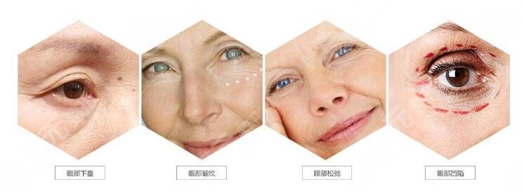 拉皮除皺手術(shù)能保持多少年?