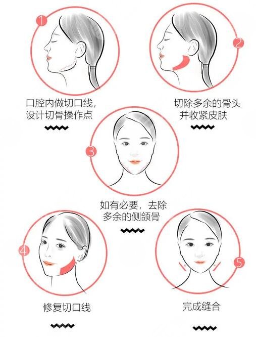 上海九院做下頜角磨骨術(shù)價(jià)格受哪些因素影響？