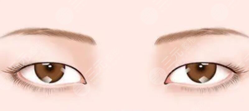 歐式雙眼皮溫暖了這個(gè)初秋 改變了容顏