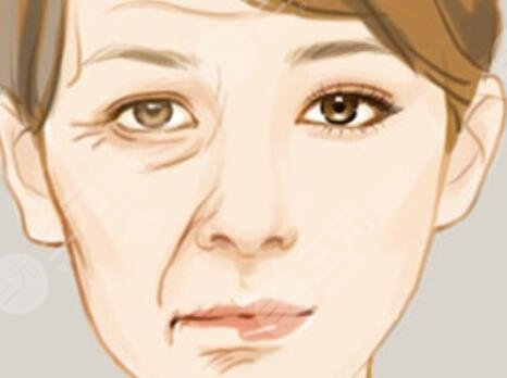 伊w蘭去皺果怎么樣？伊w蘭去皺術(shù)后對(duì)比照1