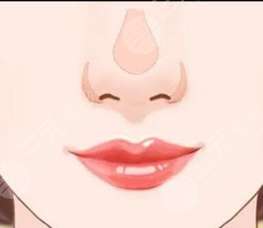 隆鼻整形手術果具體照片 手術前后對比果