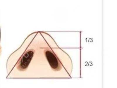 成都醫(yī)美整形劉國(guó)權(quán)隆鼻整形案例，驚人果對(duì)比