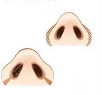 成都醫(yī)美整形劉國(guó)權(quán)隆鼻整形案例，驚人果對(duì)比