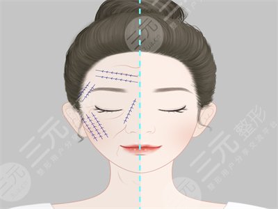 埋埋提升真人整形案例，面部對(duì)比果驚艷