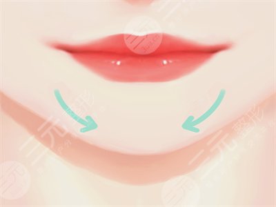 墊下巴案例 假體墊下巴恢復過程分享